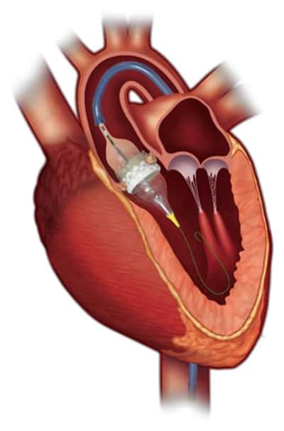 TAVI（経カテーテル大動脈弁留置術）の術式イメージ図