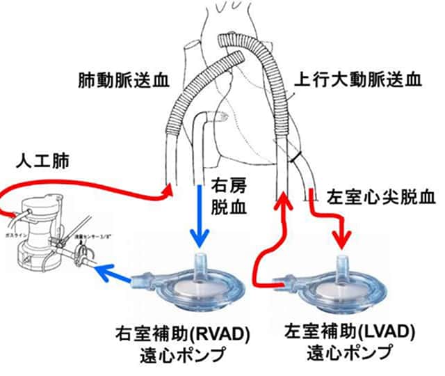 RVAD、LVAD、人工肺を用いた補助循環システムの回路構成