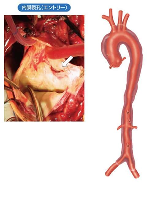 大動脈解離における内膜裂孔の写真と模式図