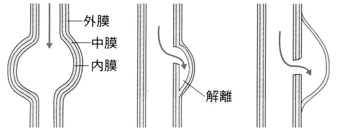正常な血管壁構造と、解離・動脈瘤のメカニズム比較図