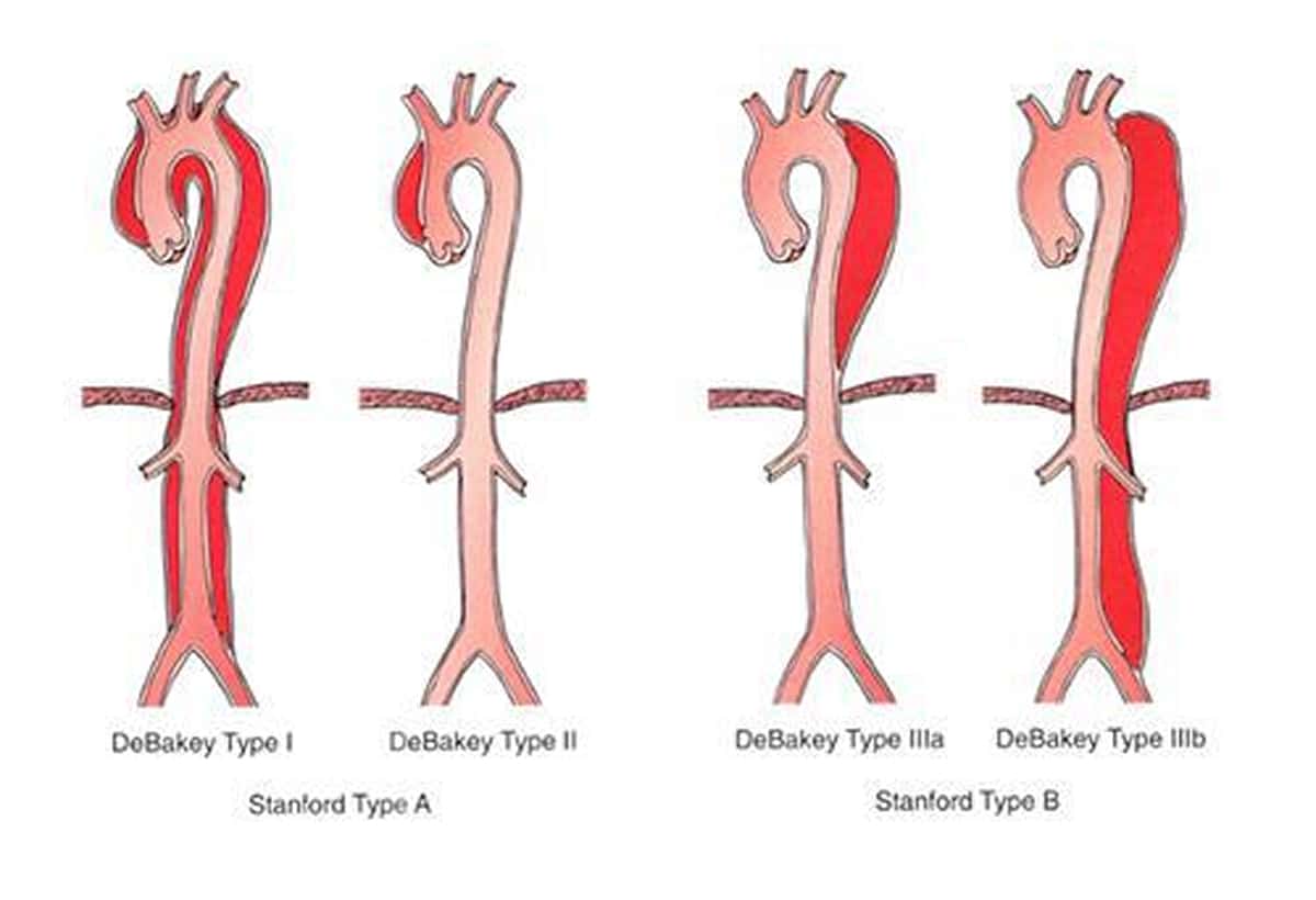 大動脈解離の分類図