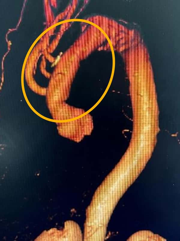 人工血管置換術