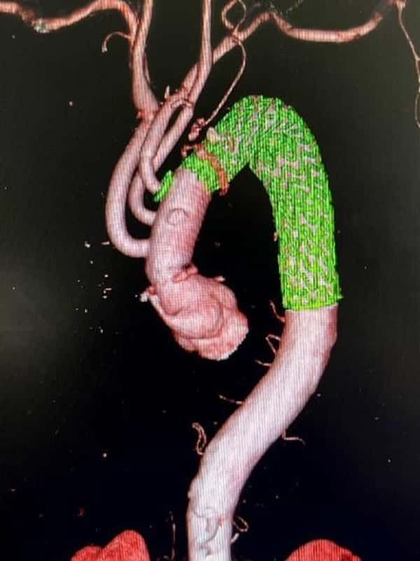 ステントグラフト置換術