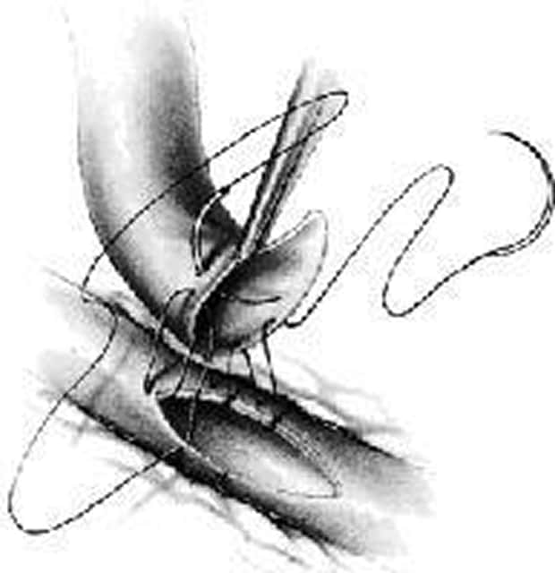 血管を縫合して吻合している手術の模式図