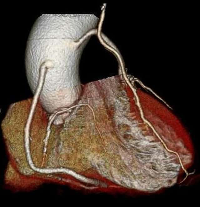 冠動脈バイパス後の血管走行を示す3D CT画像