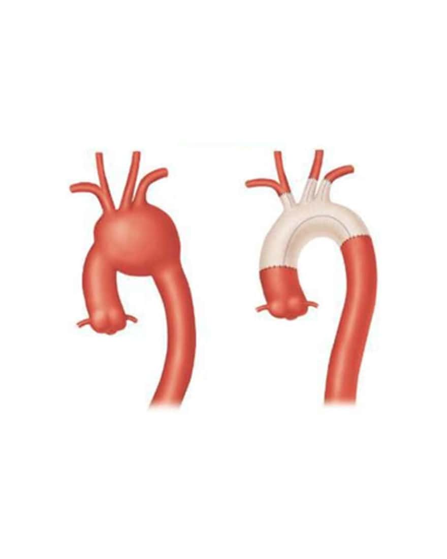 大動脈手術のイラスト