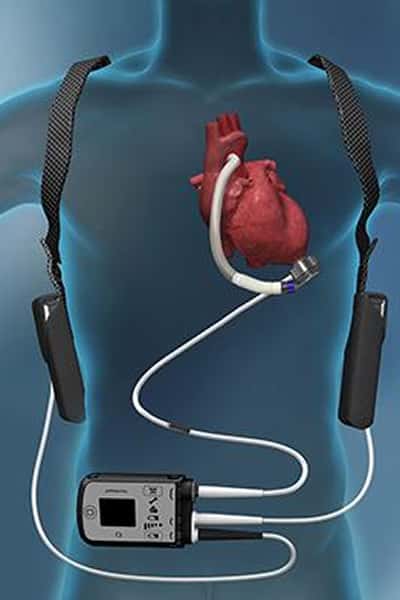 植込み型補助人工心臓と外部機器の装着図