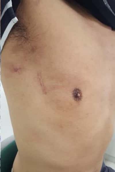 補助人工心臓手術後の胸部の傷跡