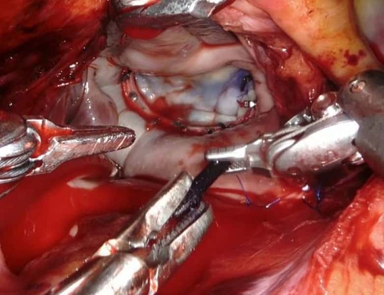 ロボット支援下心臓手術の術中視野