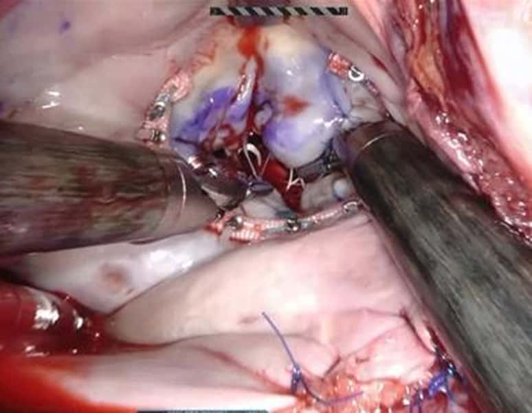 ロボット支援手術における複数の鉗子による精密操作の様子