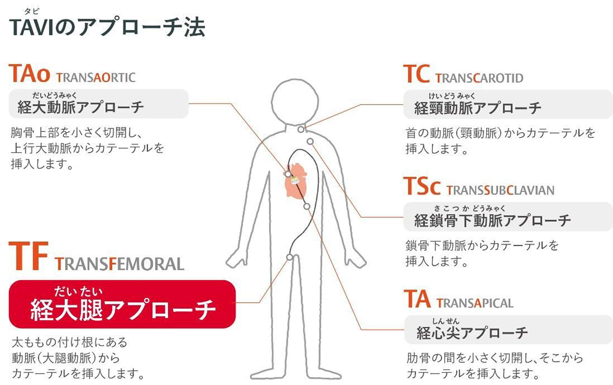 TAVIのアプローチ法図