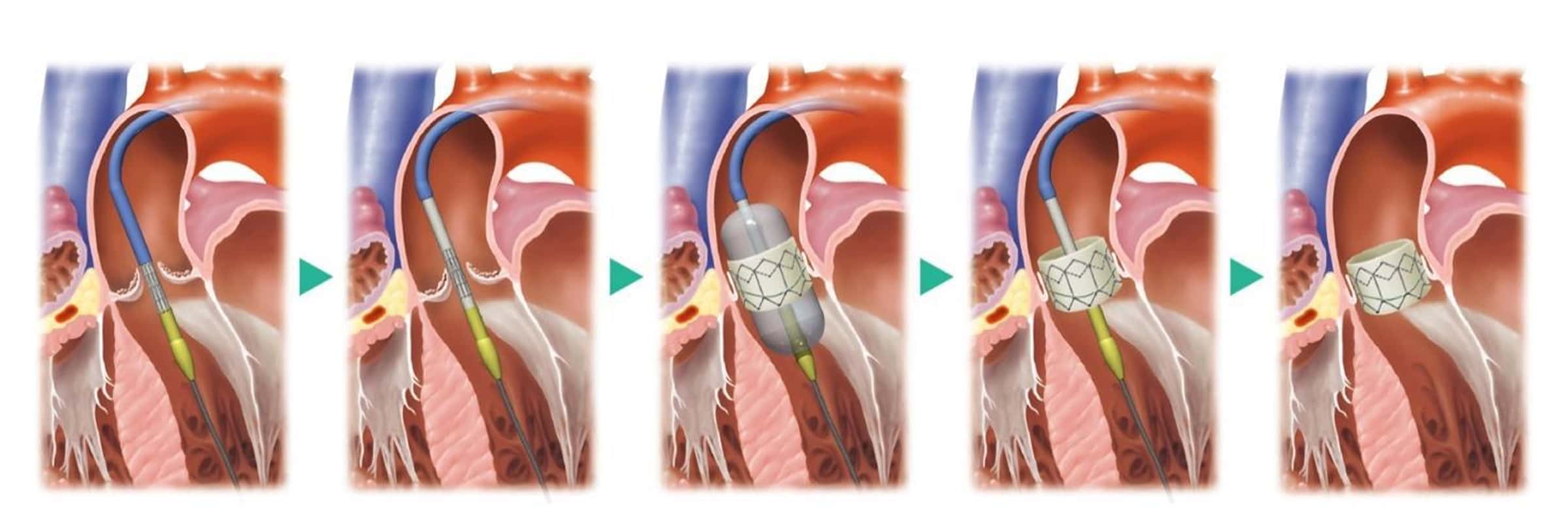 経カテーテル大動脈弁留置術（TAVI）のステップ別施行手順図