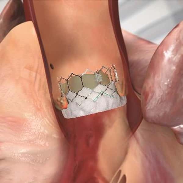 弁留置後バルーン拡張型弁