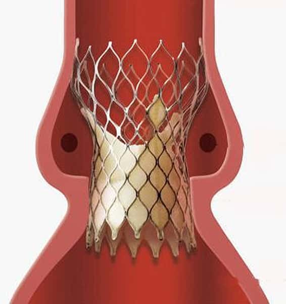 弁留置後自己拡張型弁