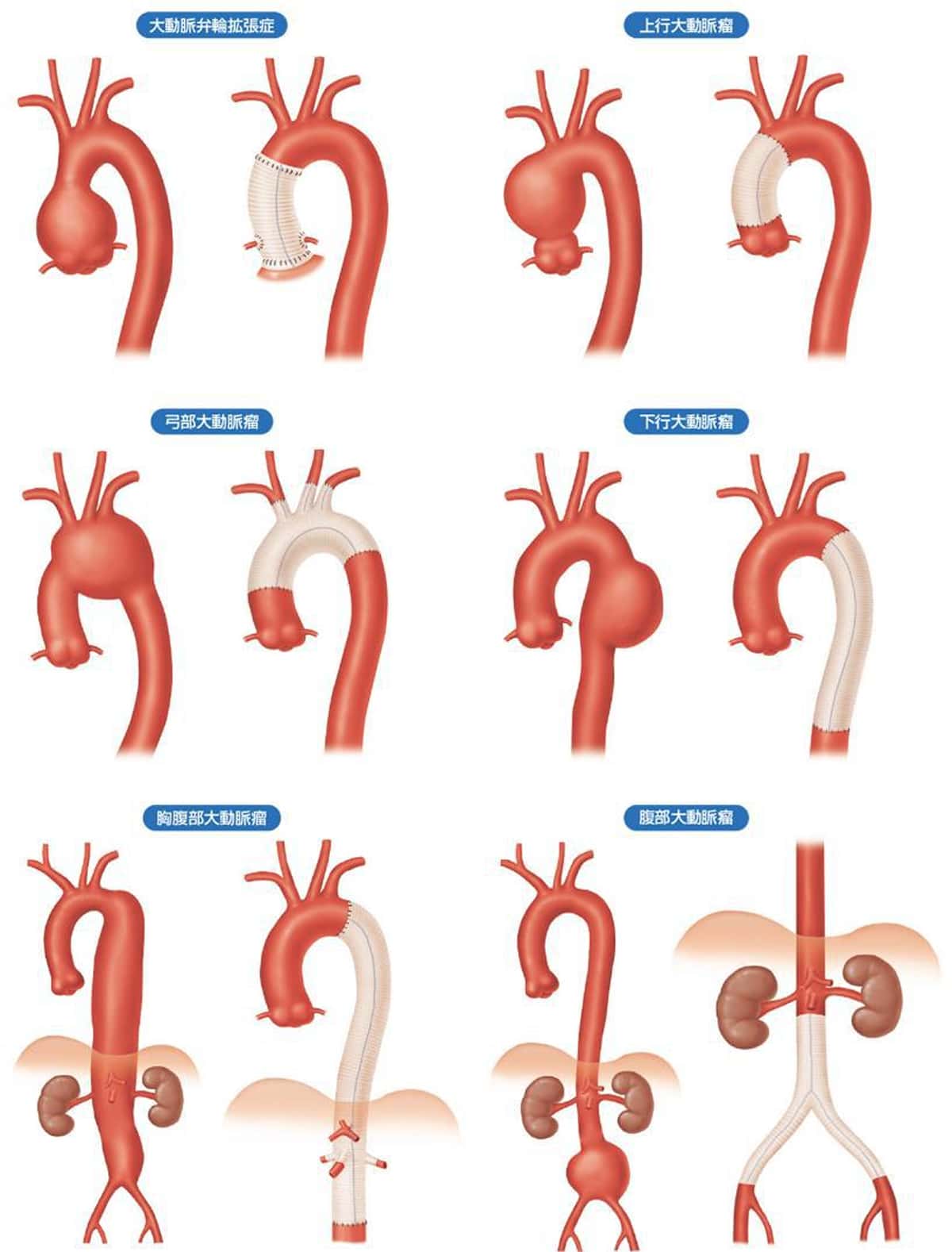 部位別の大動脈瘤と人工血管置換術の術式図一覧