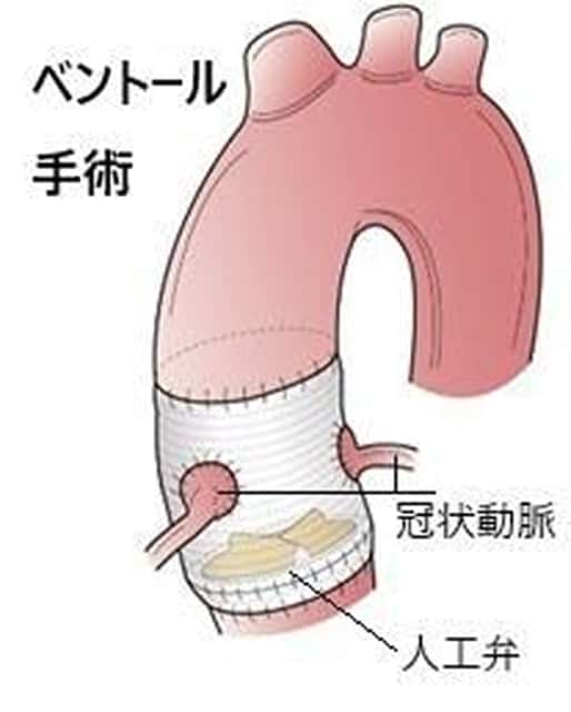 ベントール手術の模式図