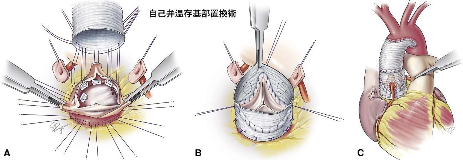 自己弁温存大動脈基部置換術の手順